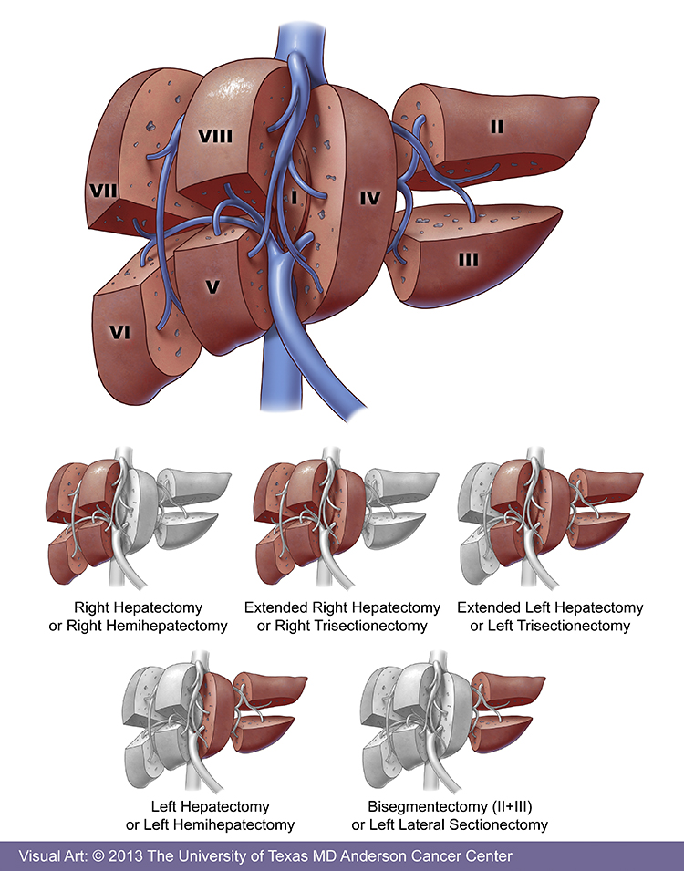 Is liver cancer easy to find in the early stages?